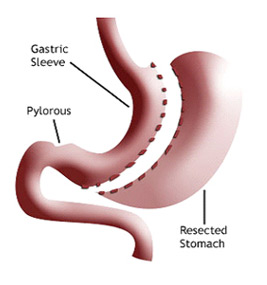 Diagram of gastric sleeve