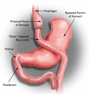 Graphic of stomach after Laparoscopic Roux-en-Y Gastric Bypass