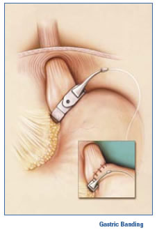 gastric banding